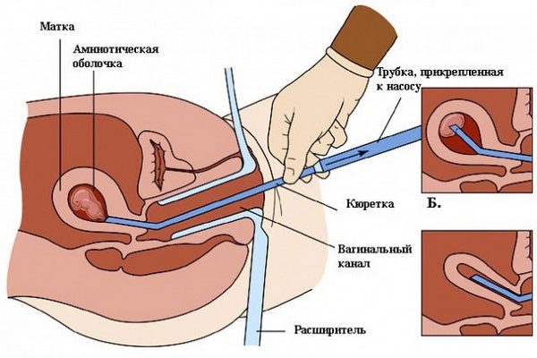 Что такое вакуумный аборт и как его делают